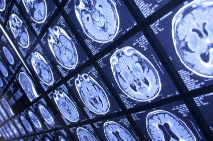 Studies Uncover Long-Term Effects of Traumatic Brain Injury