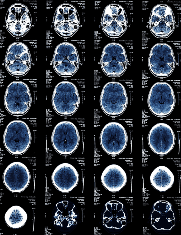 brain scan