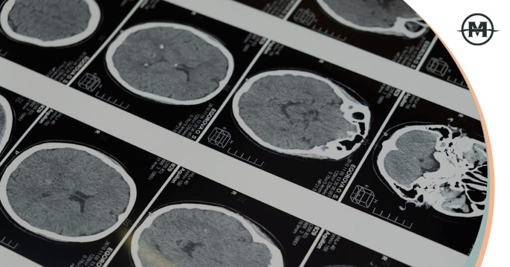 Can You Fully Recover from a Brain Injury?